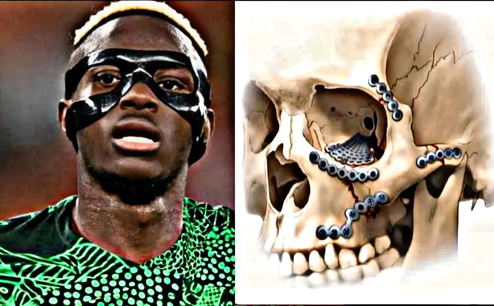 ‏لماذا لا يزال فيكتور أوسيمين يرتدي القناع حتى اليوم، رغم أن إصابته تعود إلى موسم 2021؟